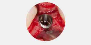 Enger Alveolarkamm im Seitenzahnbereich des Unterkiefers. 
