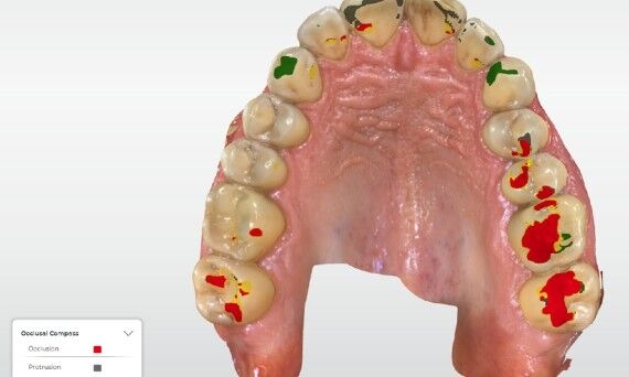 CEREC Ortho SW 2.1 - occlusal compass