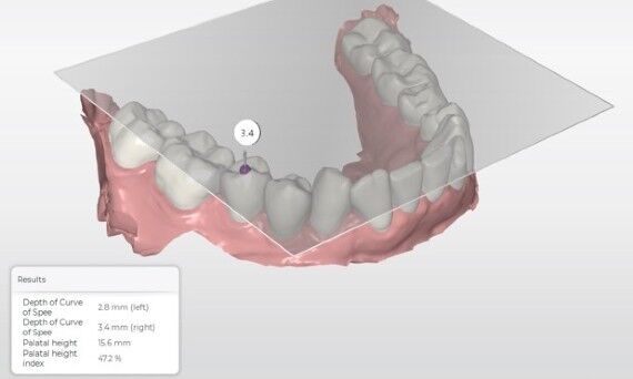 CEREC Ortho SW 2.1 - model analysis, curve spee