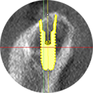 Clinical image of OsseoSpeed Profile EV dental implant