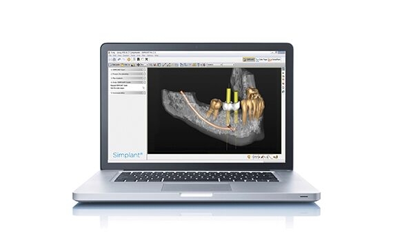 Simplant- Guided surgery