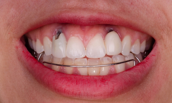 : Initial situation before Implant replacement