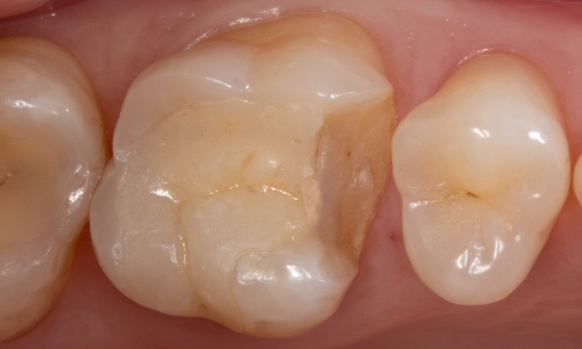 : Fractured ceramic restoration before CEREC treatment
