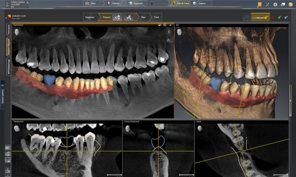 Dental implant planning software SICAT Implant