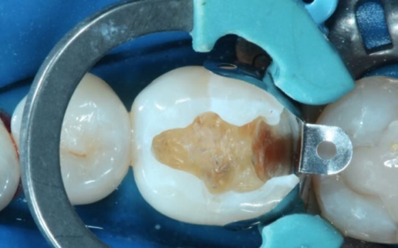 Placing Palodent V3 Dental Matrix