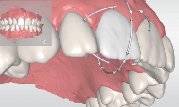 Orthodontie met CEREC Ortho Software
