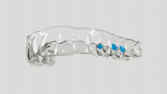 De kunststof van een SureSmile Aligner biedt uitstekende krachtoverdracht.
