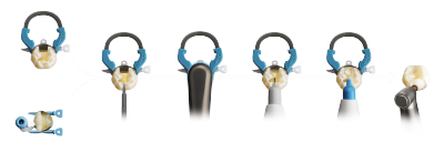Class II workflow