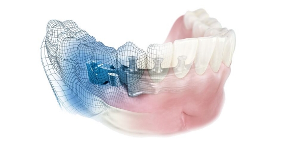 Atlantis - Restoring with the natural tooth in mind